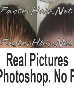 Results Before and after hair growth