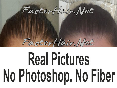 Results Before and after hair growth