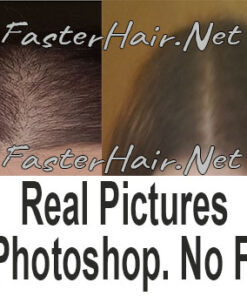 Thinning Hair Results Before and after hair growth