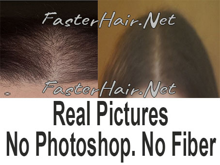 Thinning Hair Results Before and after hair growth